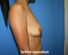 plastic-surgery-breast-augmentation
